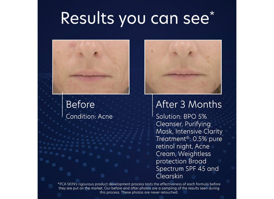 BPO 5% Cleanser